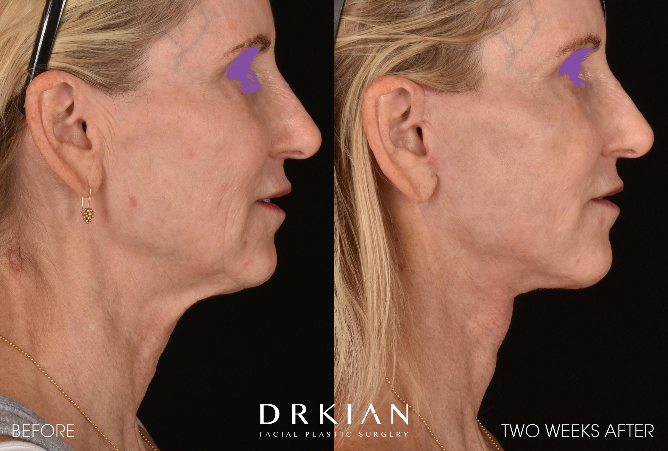Face-and-Neck-Lift-MW-BA-Template-005